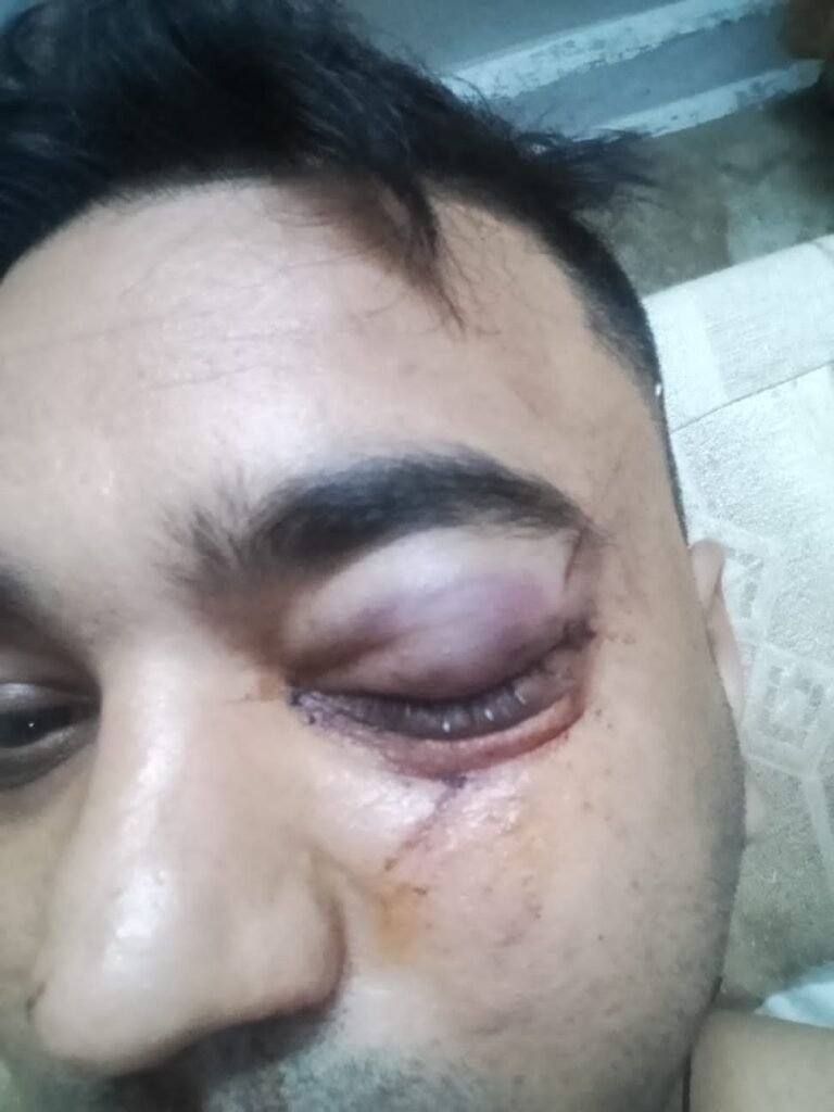सड़क पर गिरे पेड़ से टकराई बाइक, युवक गंभीर घायल 1002121503