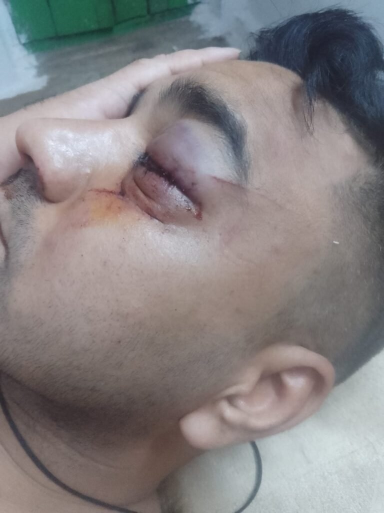 सड़क पर गिरे पेड़ से टकराई बाइक, युवक गंभीर घायल 1002121506