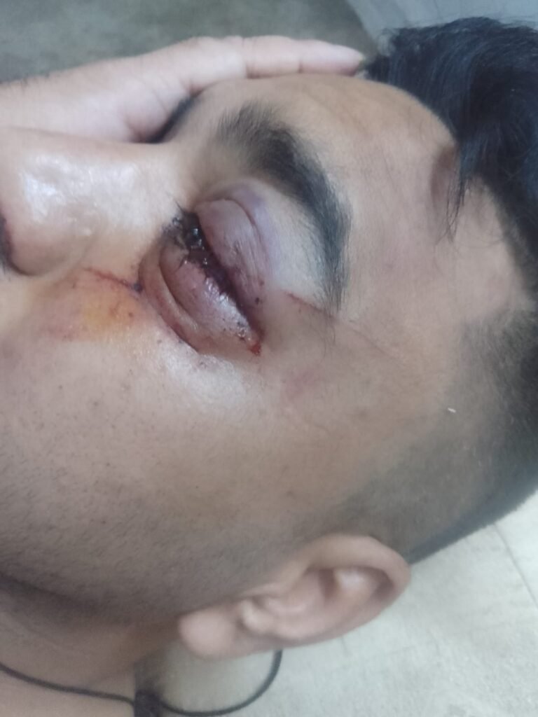 सड़क पर गिरे पेड़ से टकराई बाइक, युवक गंभीर घायल 1002121509